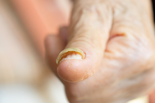 nail with advanced fungal disease