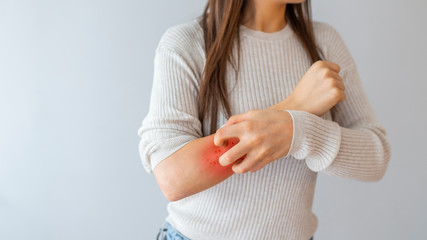 Health allergy skin care problem. Closeup young woman scratching her arm with allergy rash. Woman Scratching an itch . Sensitive Skin, Food allergy symptoms, Irritation - obrazy, fototapety, plakaty