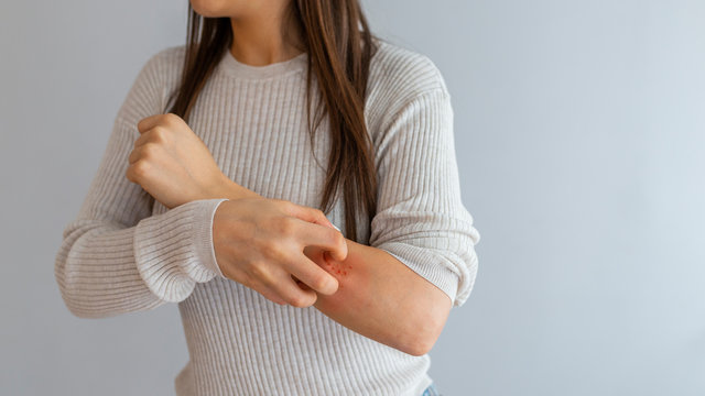 Health allergy skin care problem. Closeup young woman scratching her arm with allergy rash. Woman Scratching an itch . Sensitive Skin, Food allergy symptoms, Irritation