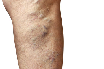 Varicose veins on a female legs. Phlebology