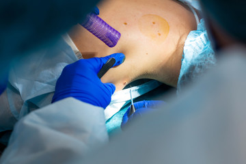 The surgeon does surgery to remove the mole on the patient's back. The process of burning moles in...