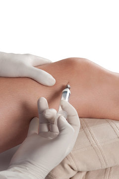 inyecci&oacute;n de rodilla, intraarticular, articulaci&oacute;n, infiltrar, dolor, alivio, jeringa, 