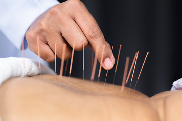 Close-up of senior female back with steel needles during procedure of acupuncture therapy - obrazy, fototapety, plakaty