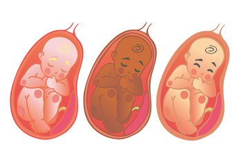 Fetal icon of different races, prenatal human child with placenta silhouette isolated on white background. Image of the baby and placenta inside the uterus. Design symbol of pregnancy.