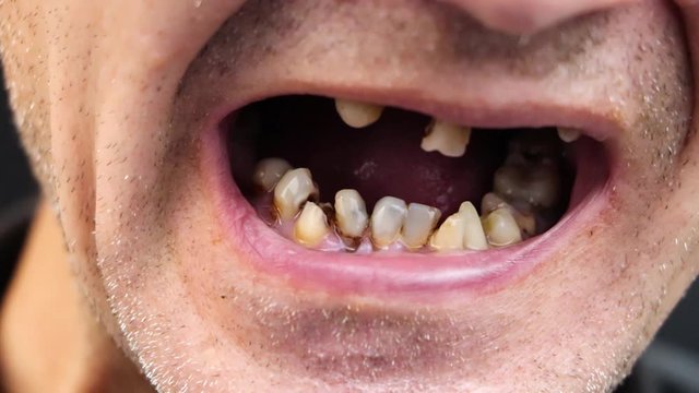 The man has rotten teeth, teeth fell out, yellow and black teeth hurt. Poor teeth condition, erosion, caries. The doctor prepares the patient for treatment