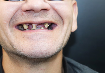 The man has rotten teeth, teeth fell out, yellow and black teeth hurt. Poor teeth condition,...