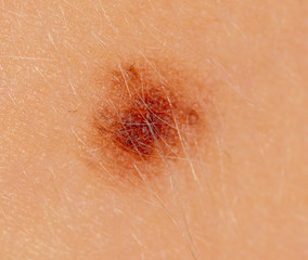 Fototapeta premium Birthmark on human skin as a background