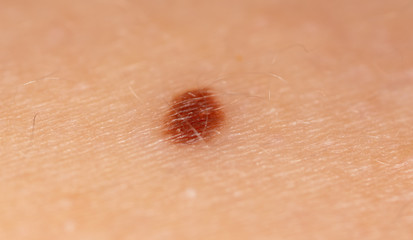 Birthmark on human skin as a background