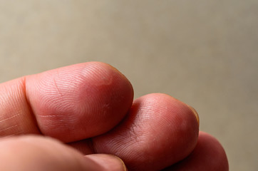 Close up wet callus or blister on the hand finger, healthcare and medical concept.