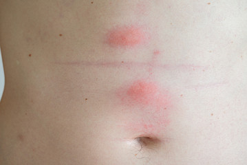 Fototapeta premium Flea bite closeup chest arm foot skin, bitten by insects bug