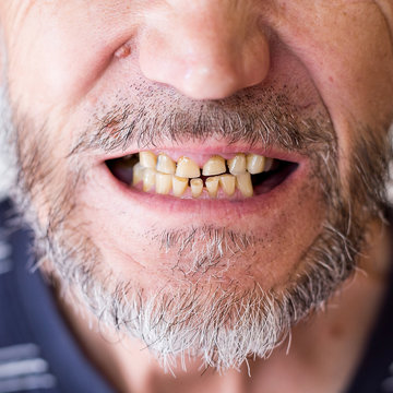 abrasion of teeth in an elderly man