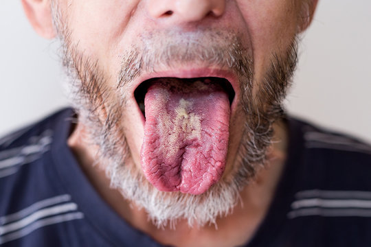 bacterial tongue disease in an older man
