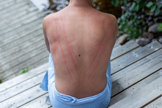 Dermatographic urticaria (also known as dermographism, dermatographism or "skin writing") is a skin disorder and one of the most common types of urticaria. Photo of skin writing on a back of a man.