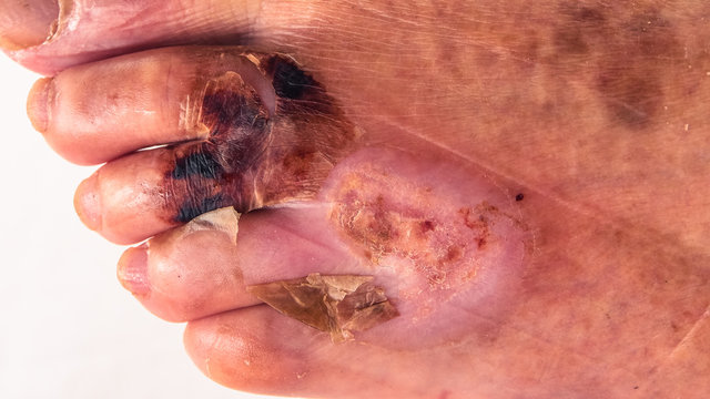 Close up of toes and foot with burn wound and bloody scab