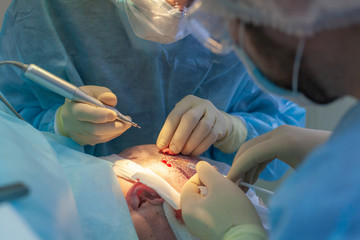 Baldness treatment. Hair transplant. Surgeons in the operating room carry out hair transplant...