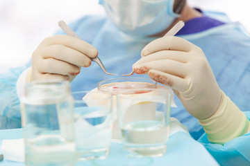 Baldness treatment. Hair transplant. Surgeons in the operating room carry out hair transplant...