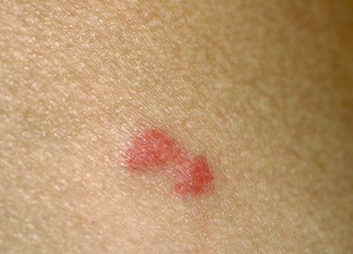 Mosquito bite on the skin. Tick bite.