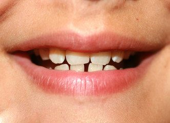 Obraz premium Incorrect bite in a child. Malocclusion in children. Crooked teeth.