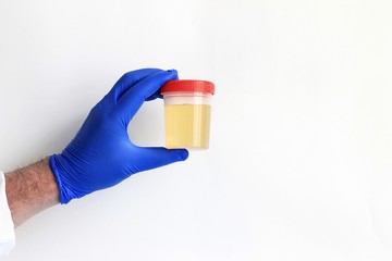 Doctor's hand in glove holding urine specimen: medical analysis. Urine analysis in the laboratory, medical urine test, urine sample for laboratory analysis.