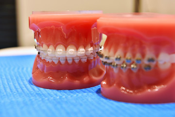 teeth model of orthodontic braces