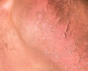 Fototapeta premium Small detail of a sunburned peeling