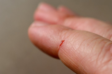 Open cut wound on the index finger