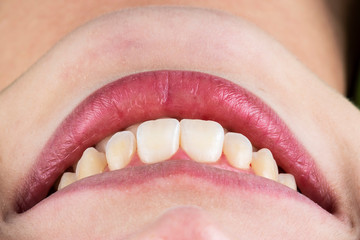 Fototapeta premium natural look ceramic veneers photoes