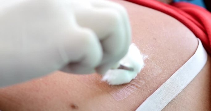 cleaning infected wound on  chest  