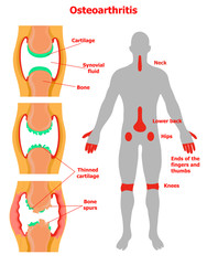 Stages of osteoarthritis and some joints that are commonly affected