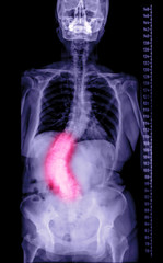 Selective Focus of Whole human Spine for diagnosis scoliosis.