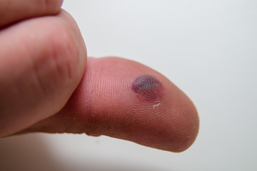 Blood blister under the thumb skin. Caucasian young man finger on white background.