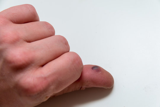 Blood blister under the thumb skin. Caucasian young man finger on white background