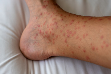 Naklejka premium Close up of redness, itching and swelling after many mosquitos bite on the leg - allergy to mosquito saliva can cause papular hives or Skeeter's syndrome