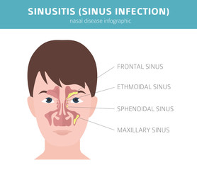 Nasal diseases. Sinusitis, sinus infection diagnosis and treatment medical infographic design