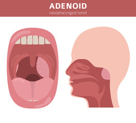 Nasal and throat, nasopharynx diseases. Adenoids diagnosis and treatment medical infographic design