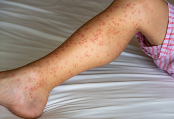 Close up of redness, itching and swelling after many mosquitos bite on the leg - allergy to mosquito saliva can cause papular hives or Skeeter's syndrome
