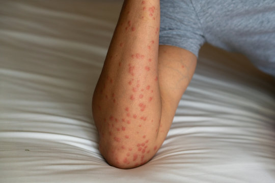 Close up of redness, itching and swelling after many mosquitos bite on the arm - allergy to mosquito saliva can cause papular hives or Skeeter's syndrome.