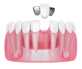 3d render of jaw with teeth and maryland bridge