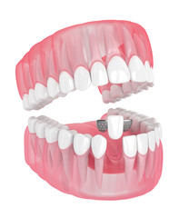 3d render of jaw with teeth and maryland bridge