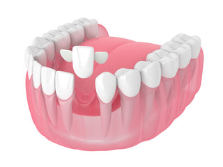 3d render of jaw with teeth and maryland bridge