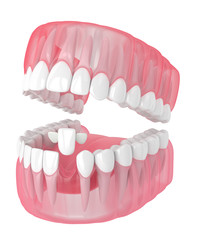 3d render of jaw with teeth and maryland bridge