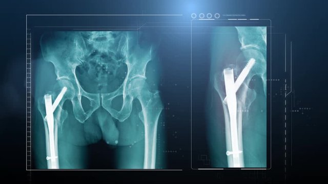 Y-strut hip fixation in blue tone footage, 4K hip x-ray with close up to fixation device and red hight light at hip