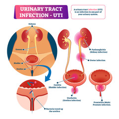Urinary tract infection or UTI vector illustration. Labeled medical scheme.