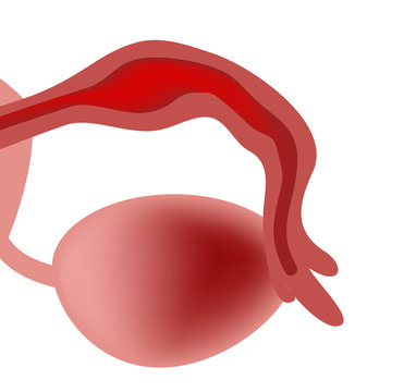 Salpingitis. Inflammation of the fallopian tube. Oophoritis. the ovary. pelvic organs. Infographics. Vector illustration on isolated background