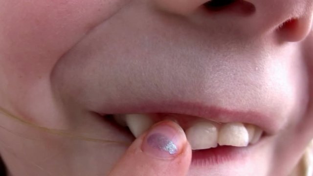 A Loose Tooth Gets Wiggled By A Young Kid.