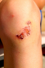 Fototapeta premium Dried blood on the scratch on the knee after falling.