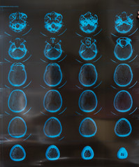 MRI or magnetic resonance image of head and brain scan. Close up view, toned image