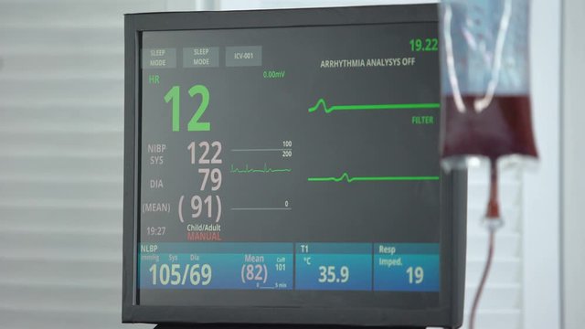 Heart rate falling to zero on ecg monitor in reanimation room, blood transfusion