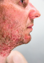Fototapeta premium Detail of man's chin with seborrheic dermatitis in the beard area