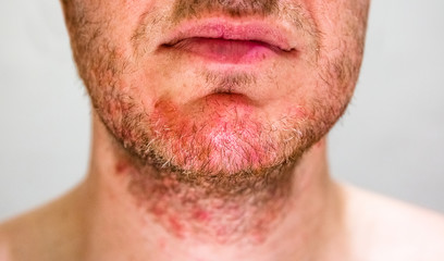 Detail of man's chin with seborrheic dermatitis in the beard area